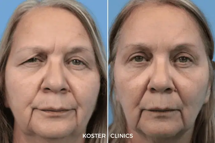 Wenkbrauwlift voor en na koster 2