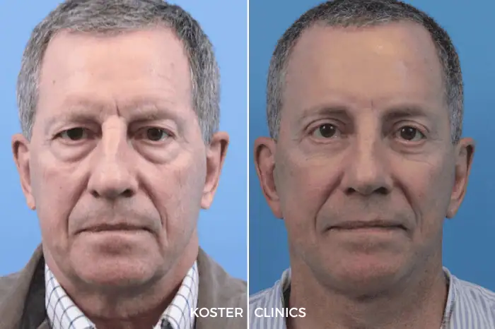 Wenkbrauwlift voor en na koster