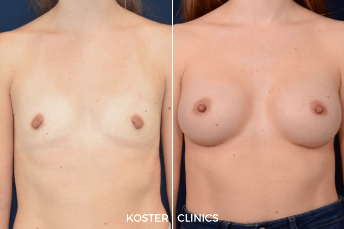 Borstvergroting voor en na Borstvergroting voor en na
