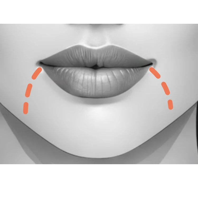 Kaaklijn met fillers Hangende mondhoeken