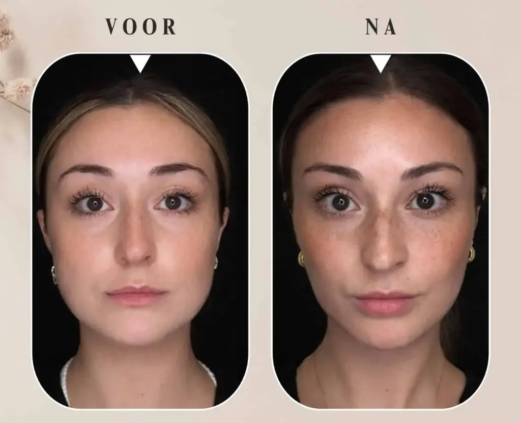face slimming behandeling