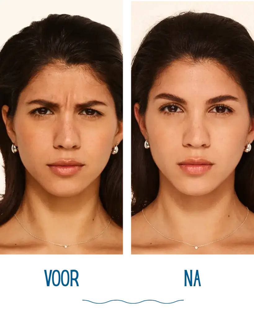 fronsrimpels precies voor en na