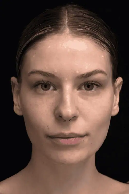 Face slimming voor en na