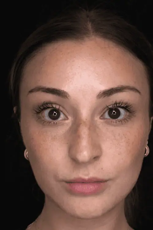 Face slimming voor en na