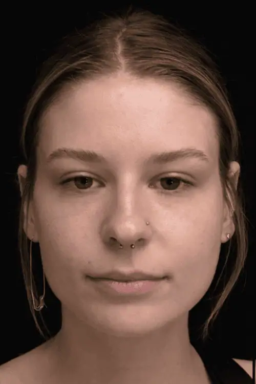 Face slimming voor en na