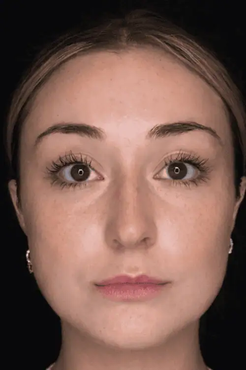 Face slimming voor en na